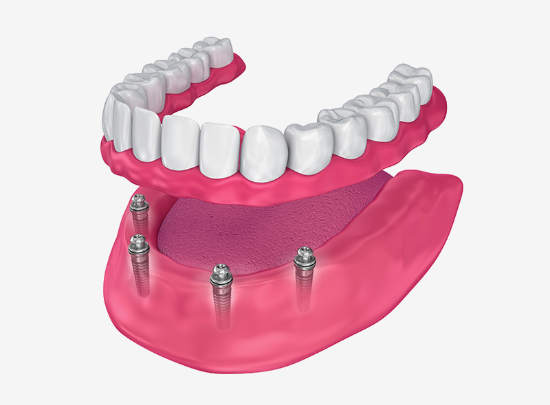 dental implants colchester